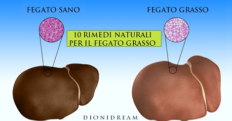 1 SU 5 HA IL FEGATO INGROSSATO: ECCO 10 RIMEDI NATURALI